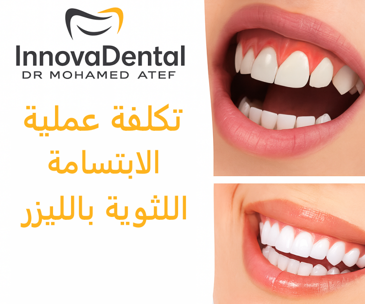 Cost of laser gummy smile surgery: A comprehensive guide to prices and influencing factors